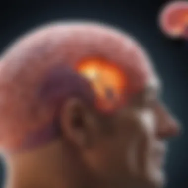 Diagram showing seizure activity related to gangliogliomas