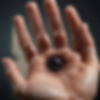 Acral Lentiginous Melanoma on Palm Visual representation of acral lentiginous melanoma on palm