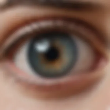 Increased Pressure from Glaucoma Illustration showing increased pressure on the optic nerve due to glaucoma